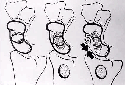 [Schema di osteosintesi]